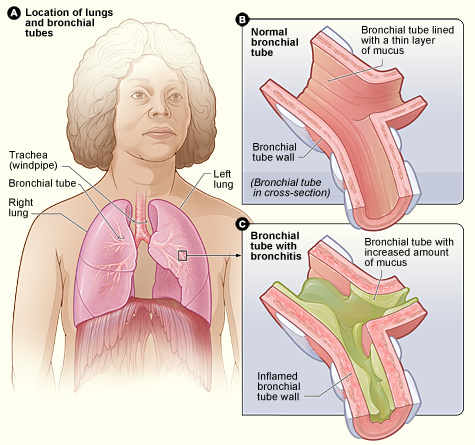 Difference Between Bronchitis and Whooping Cough