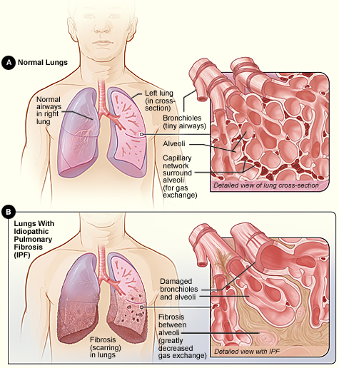 Cystic Fibrosis vs Pulmonary Fibrosis