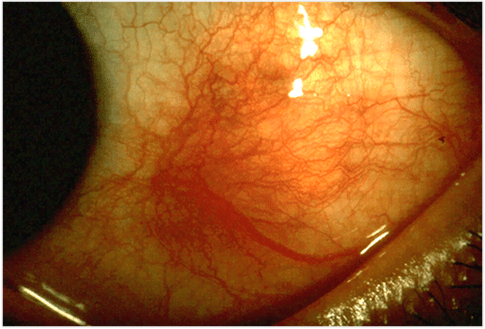 Key Difference - Scleritis vs Episcleritis