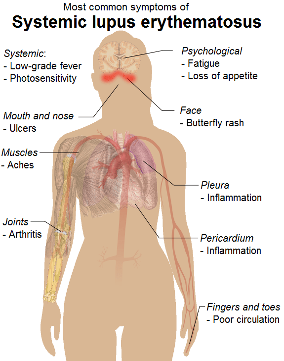 Difference Between Autoimmune Disease and Immune Deficiency 