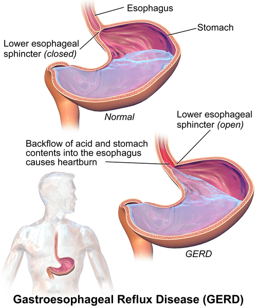 Key Difference - Bronchospasms vs Laryngospasms