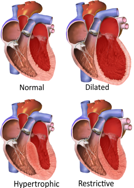 Difference Between Cardiomyopathy and Congestive Cardiac Failure 