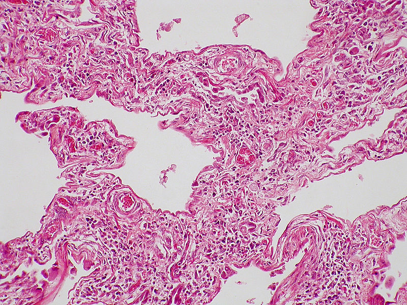 Difference Between Fibrosis and Cirrhosis