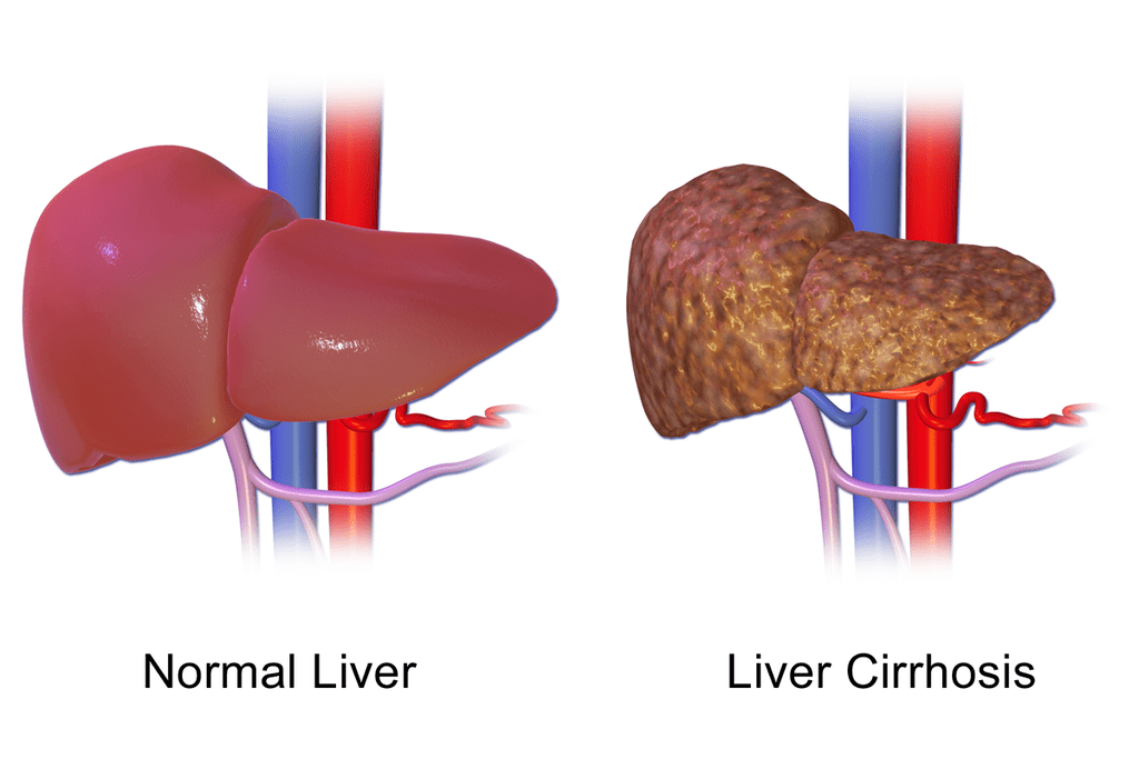 Key Difference - Fibrosis vs Cirrhosis 