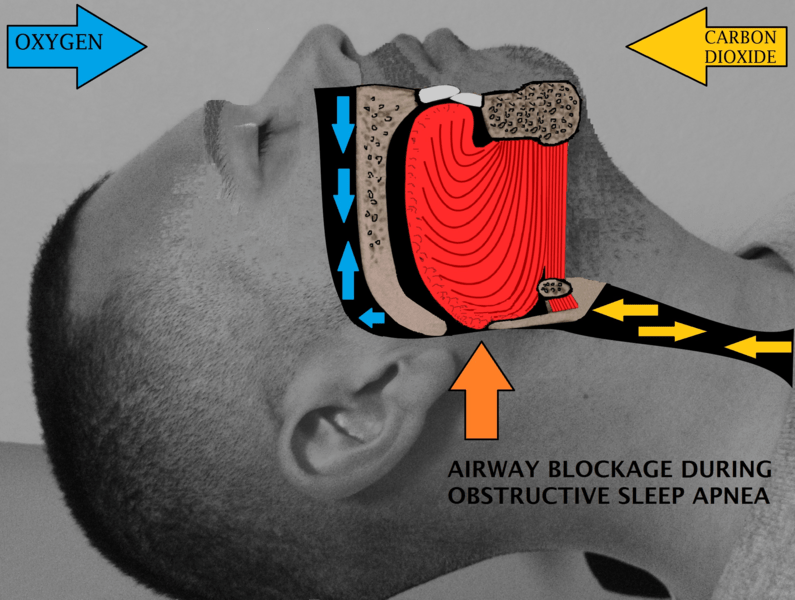 Difference Between Apnea and Dyspnea 