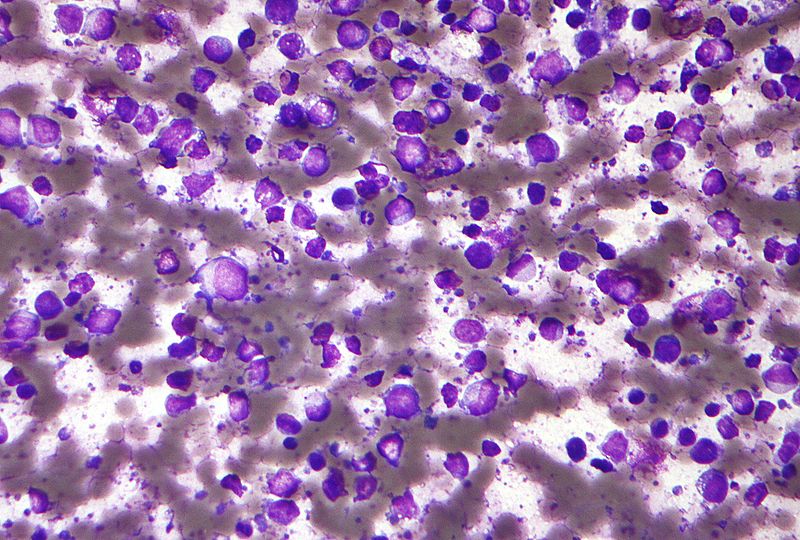 Key Difference - B Cell vs T Cell Lymphoma 