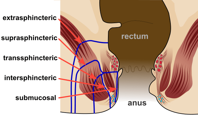 Difference Between Piles and Fistula 