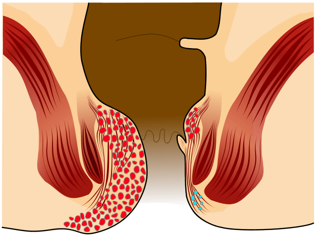 Key Difference - Piles vs Fistula 