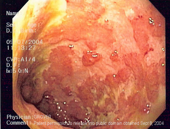 Key Difference - Diverticulitis vs Ulcerative Colitis 