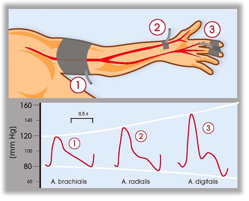 Key Difference Between Invasive and Noninvasive Blood Pressure