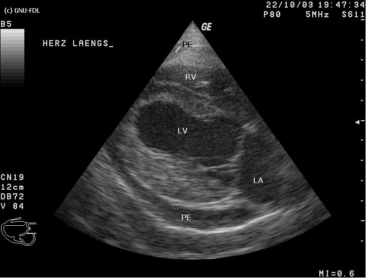 Key Difference - Pericardial Effusion vs Cardiac Tamponade