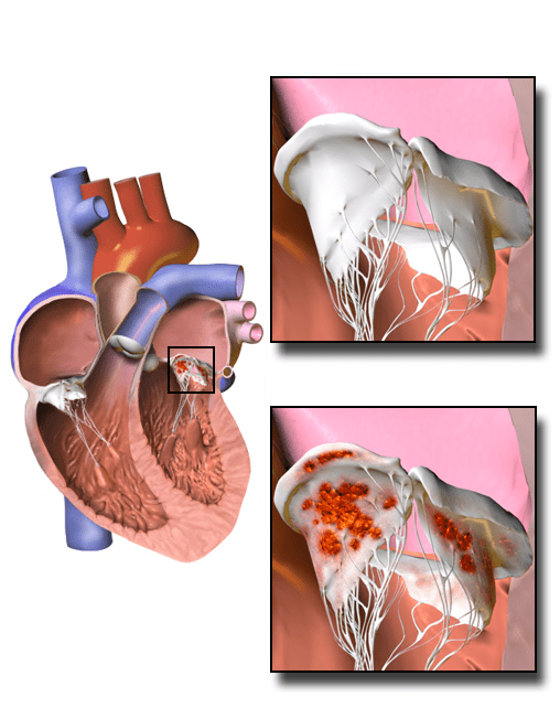 Difference Between Acute and Subacute Endocarditis