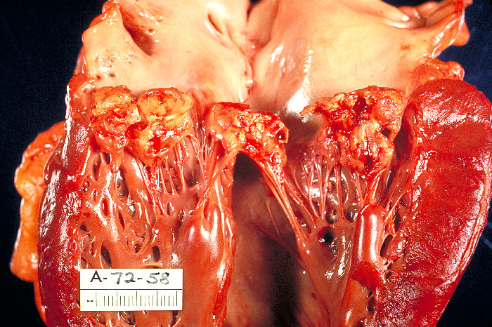 Key Difference Between Acute and Subacute Endocarditis