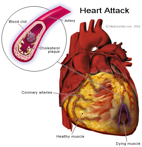 Key Difference Between Ischemia and Infarction