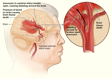 Key Difference Between Ischemic and Hemorrhagic Stroke