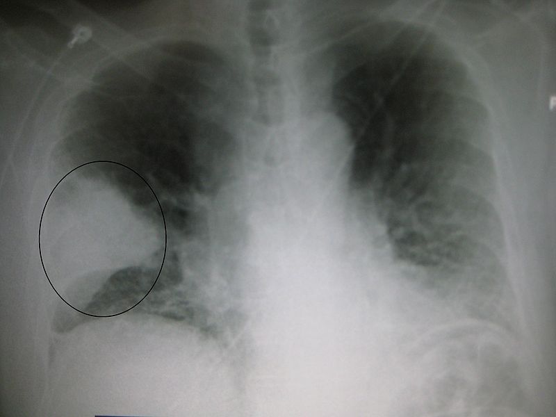 Difference Between Lobar Pneumonia and Bronchopneumonia