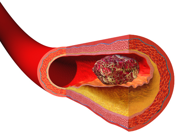 Difference Between Blood Clot and Tissue 