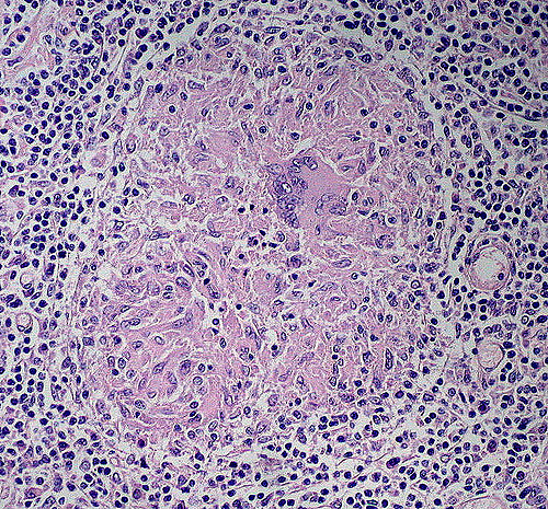 Key Difference - Caseating vs Noncaseating Granuloma