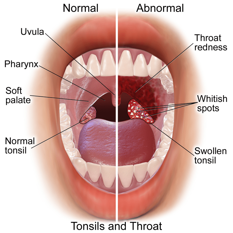 Difference Between Tonsillitis and Glandular Fever