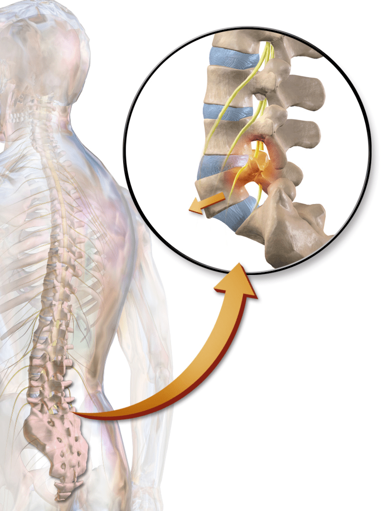 Key Difference Between Spondylosis and Spondylolisthesis 