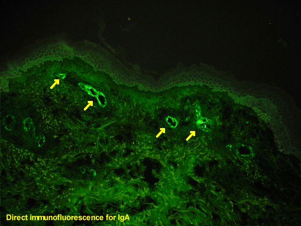 Difference Between Direct and Indirect Immunofluorescence_Fig 01