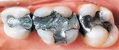 Key Difference - Alloy vs Amalgam