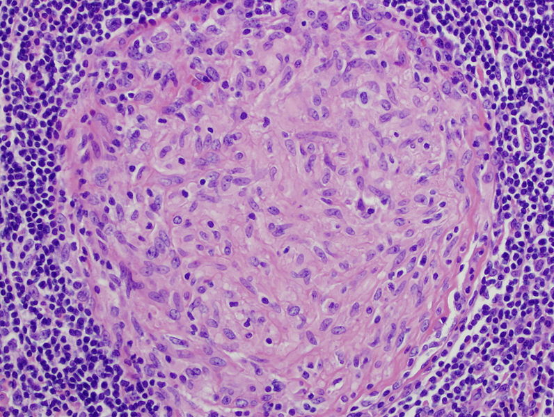 Key Difference - Granulation Tissue vs Granuloma