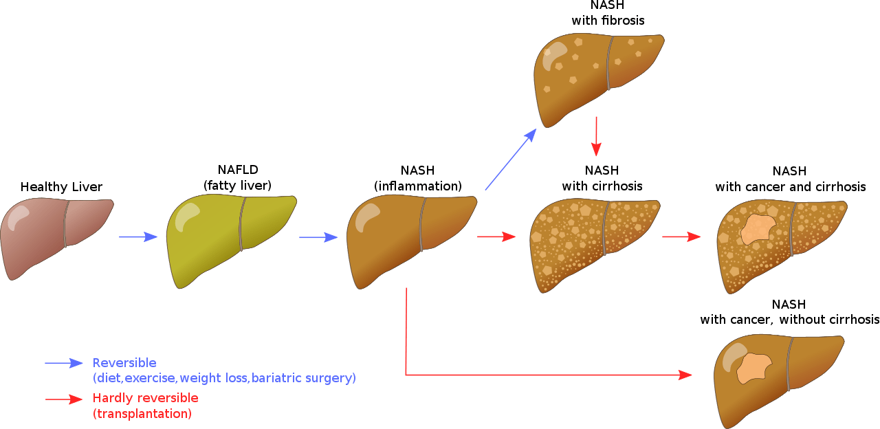 Difference Between Alcoholic and Non-alcoholic Fatty Liver