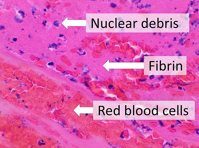 Fibrin vs Slough