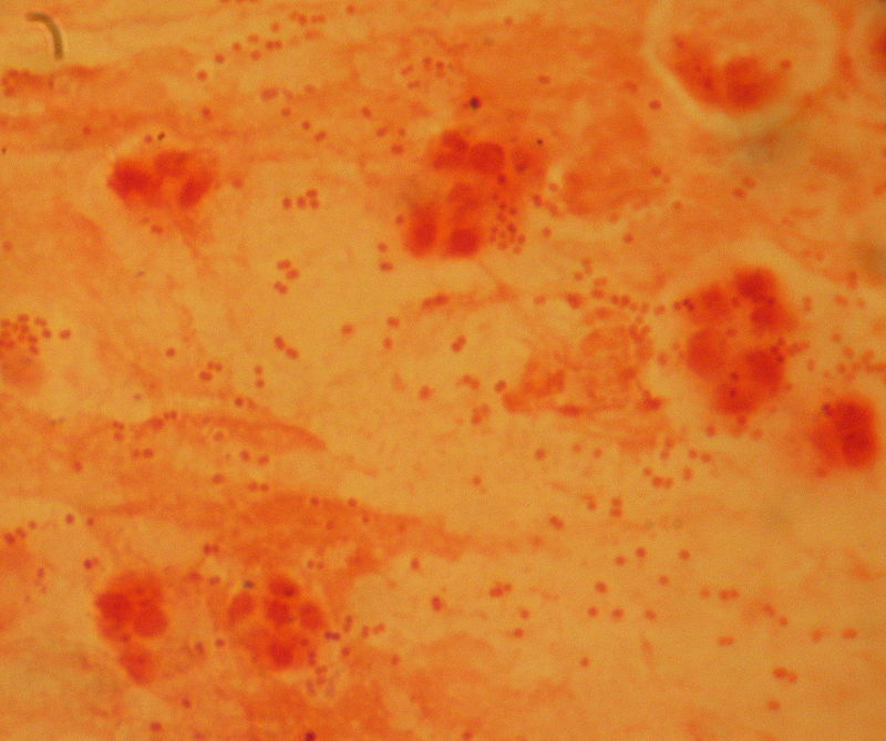 Haemophilus Influenzae vs Haemophilus Parainfluenzae in Tabular Form