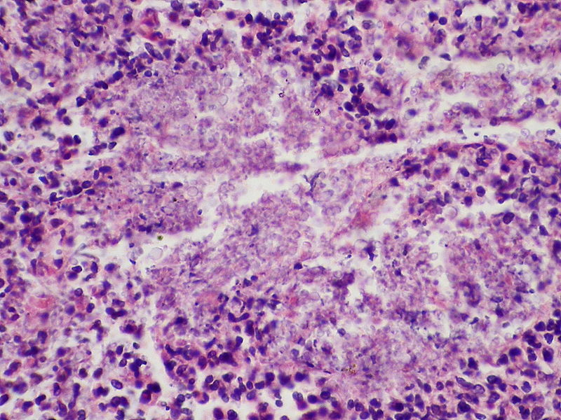 Candida Albicans and Candida Auris - Side by Side Comparison 