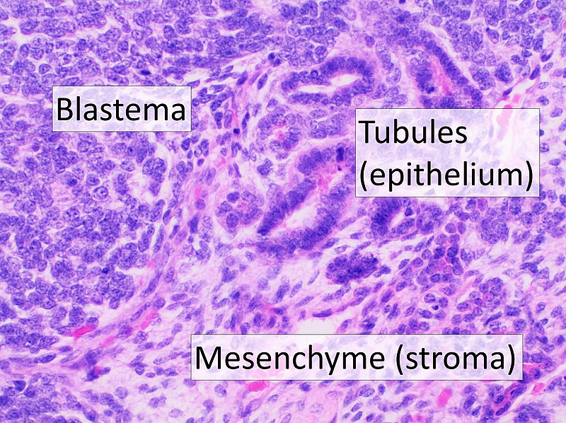  Neuroblastoma and Wilms Tumor - Side by Side Comparison 