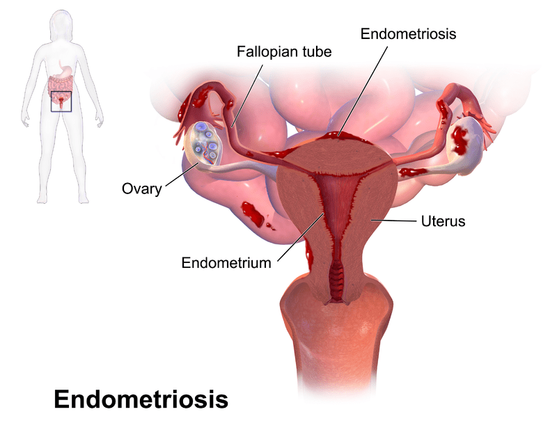 Dysmenorrhea and Endometriosis - Side by Side Comparison 