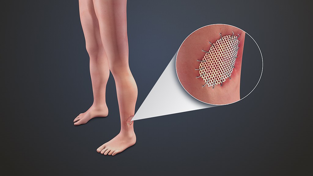  Skin Grafting vs Plastic Surgery in Tabular Form