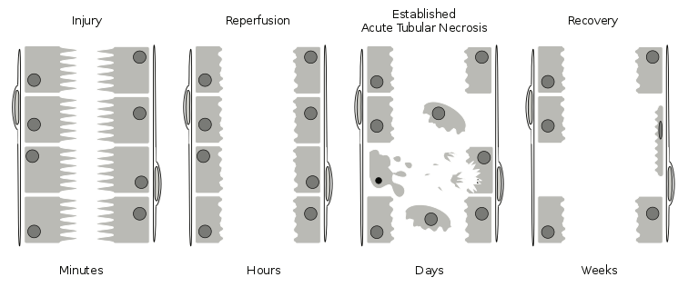 AKD vs CKD in Tabular Form