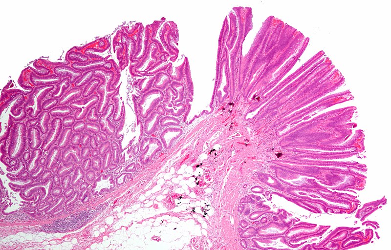 Adenoma vs Polyp in Tabular Form