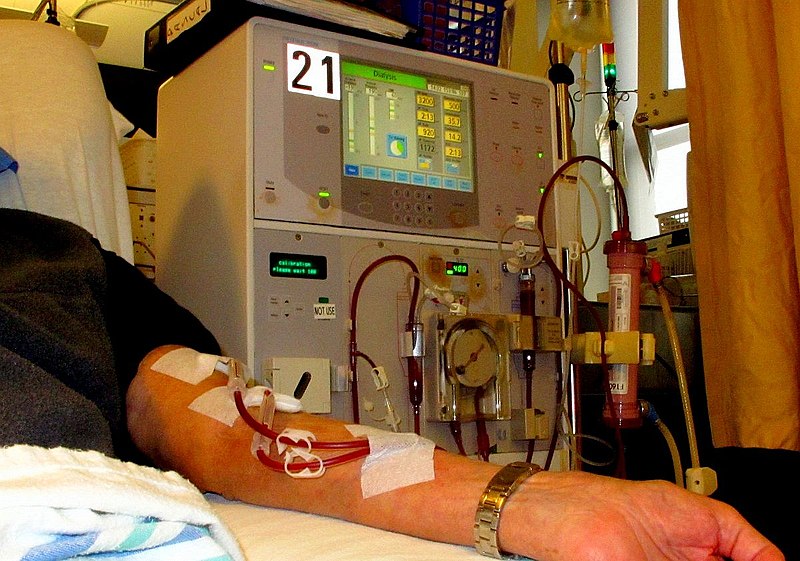 Apheresis and Dialysis - Side by Side Comparison 