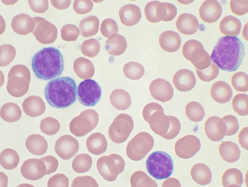 B Cell and T Cell Leukemia - Side by Side Comparison