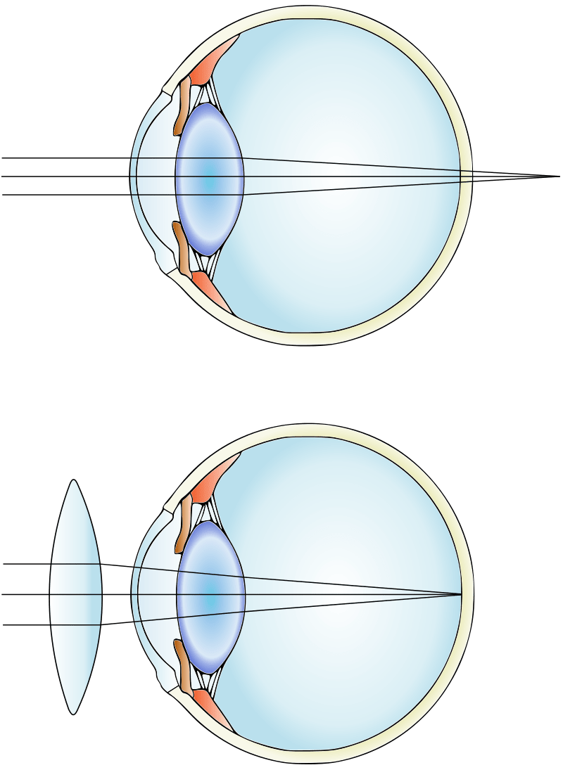 Hypermetropia and Myopia - Side by Side Comparison