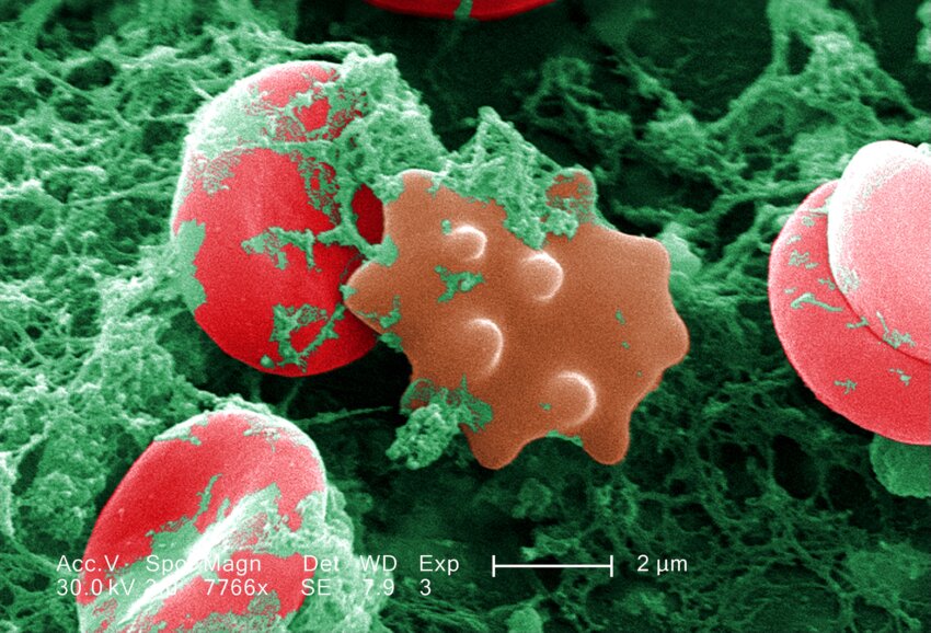 Hemolysis vs Crenation in Tabular Form