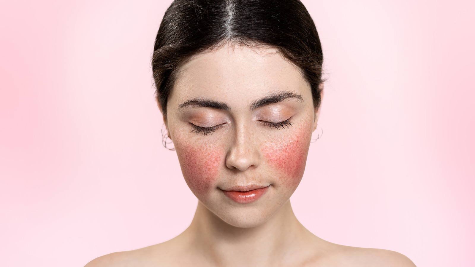 Does A Butterfly Rash Always Mean You Have Lupus?