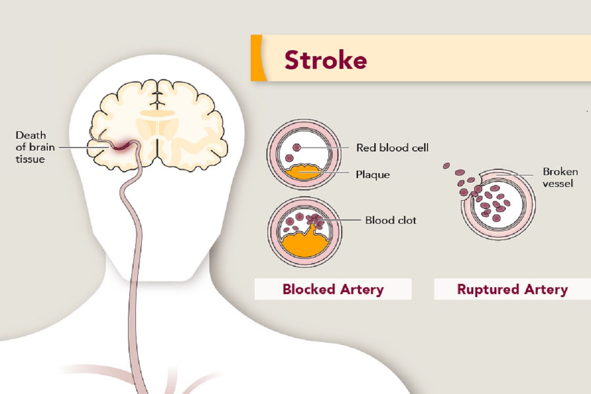 Stroke Causes, symptoms and treatment Metro Group of Hospitals