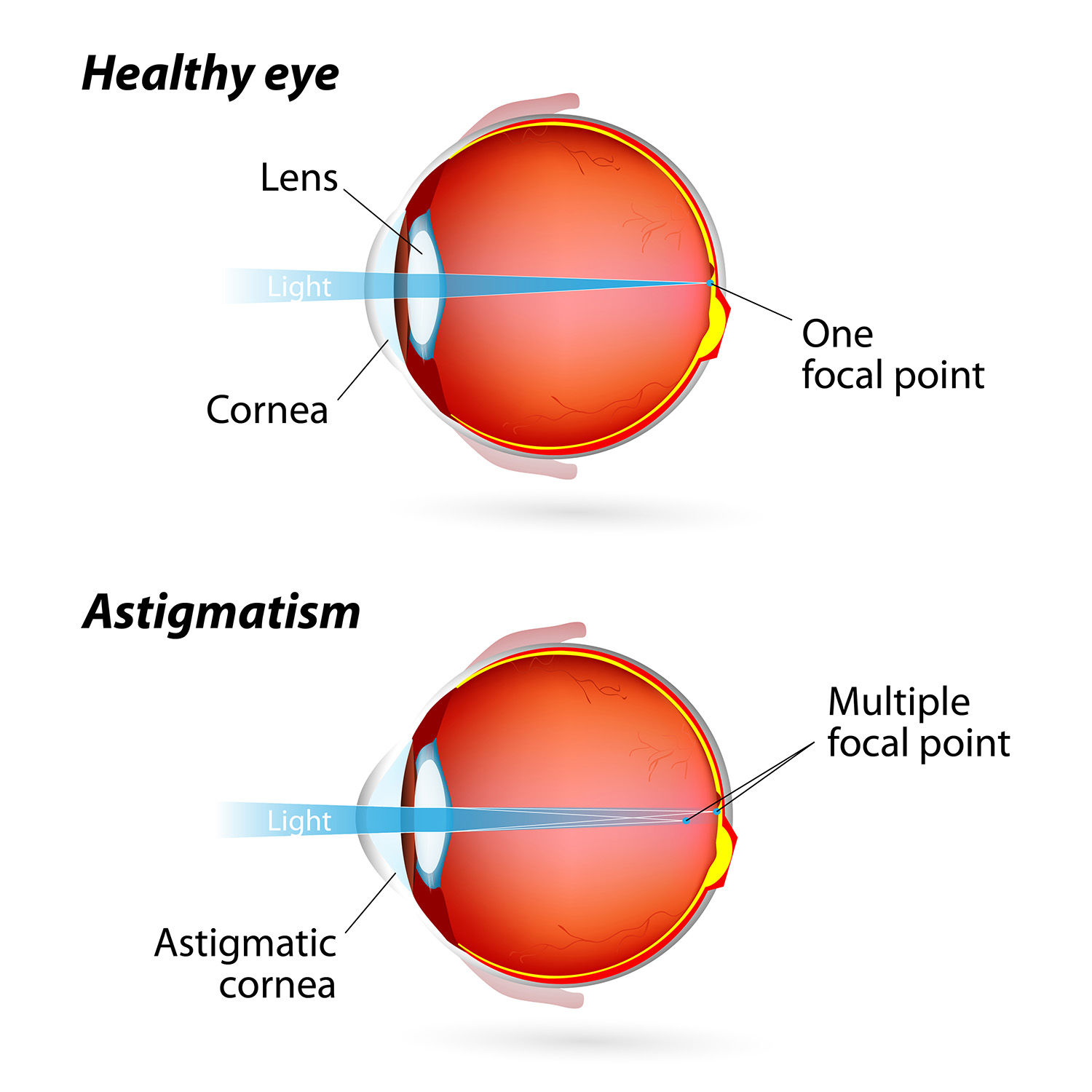 LASIK For Astigmatism Laser Eye Surgery in Northeast Ohio