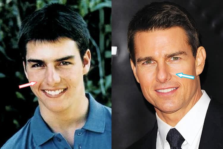 Did Tom Cruise Have Plastic Surgery? (Before & After Photos)