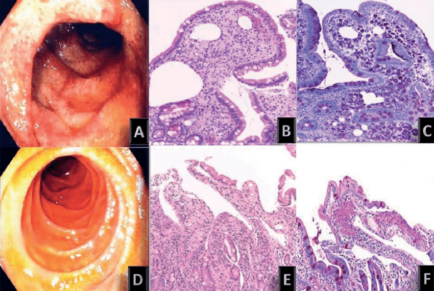 Erythematosus duodenal mucosa with diffuse haemorrhagic suffusions (A