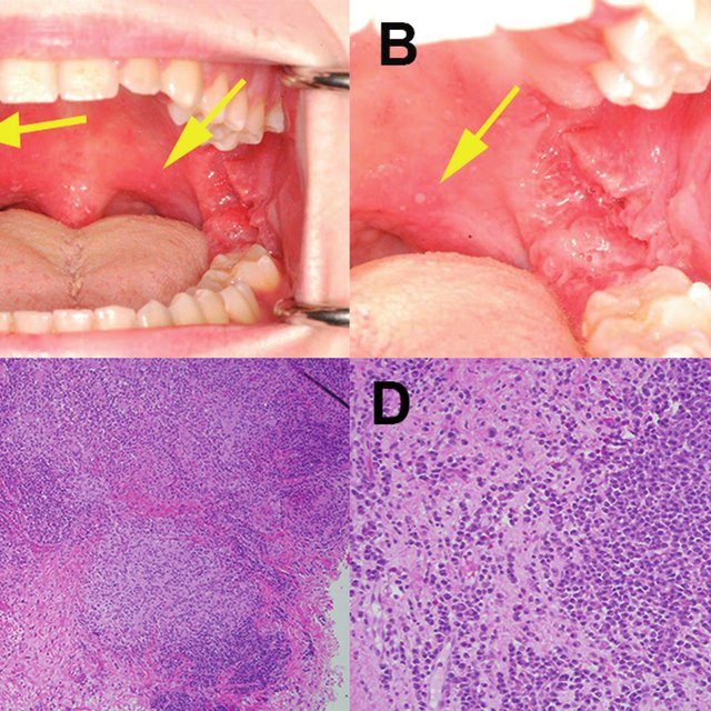(A,B) Areas of mildly erythematous mucosa and multiple aphthous ulcers