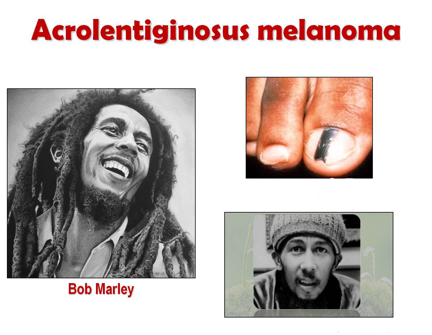 Bob Marley Hemi Ded Blong Skin Cancer Yu Tu Mus Luk Aot Long Sun Se