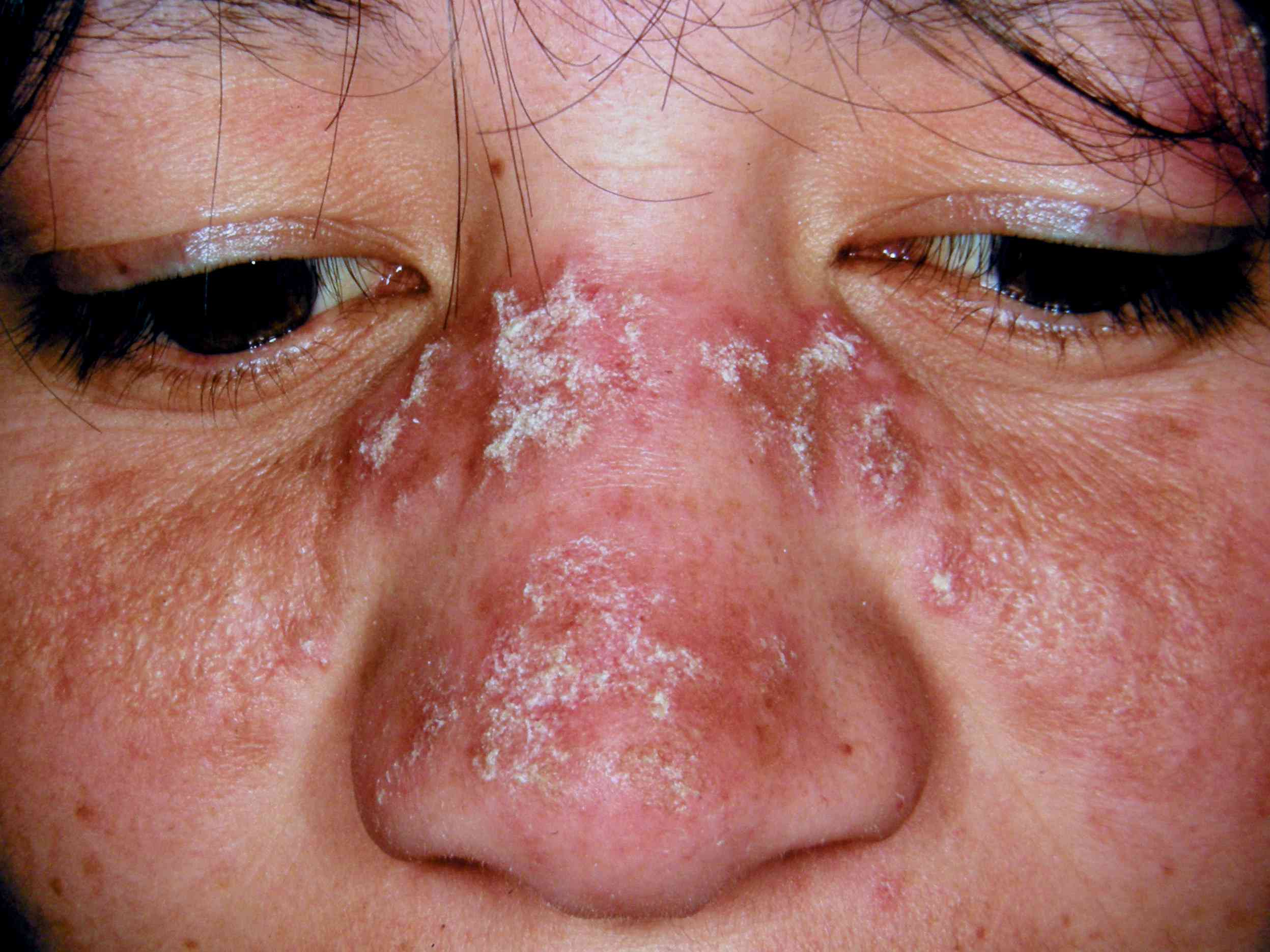 Could It Be Lupus? Signs and Symptoms (2023)