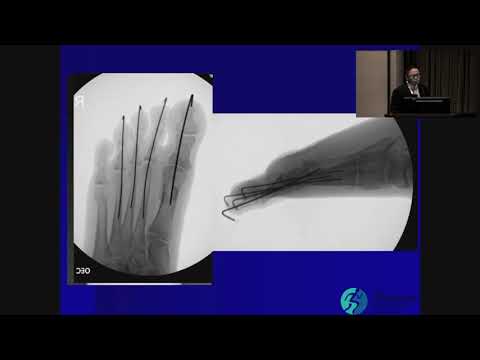Common Foot Fractures - Kevin White, DO
