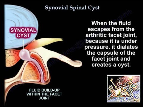 Synovial Cyst Of The Spine - Everything You Need To...